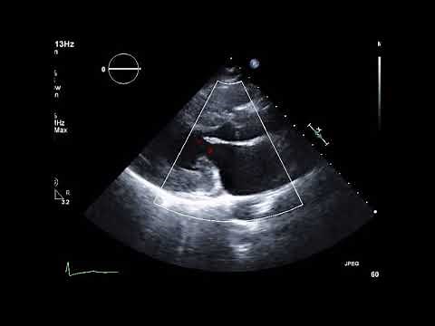 Transthoracic Echocardiography: Hypertrophic obstructive cardiomyopathy 3, SAM (LAX Color Doppler)