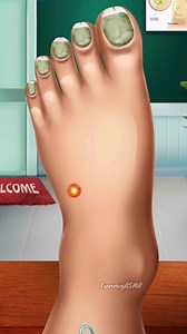 Remove Down Feet_ Dirt Clean One Pop acne Cutting fingers🤞🏻nail #footcare #satisfying #shorts #asmr #asmrvideo #fbreels #footcare #FootCareRoutine #animation #relax #reelschallenge #reelsfacebook #treatment #fb #reelstrending Tunnig ASMR | Tunnig ASMR