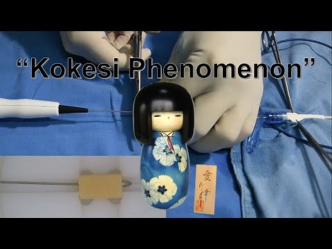 Resolution of Rotablation complications: Burr remove by guide extension catheter