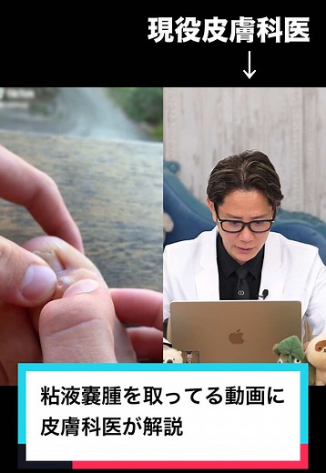 粘液嚢腫についての皮膚科医の解説