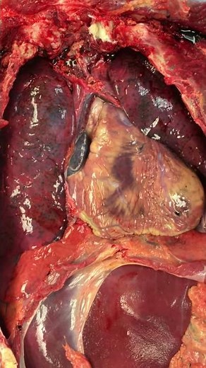 Autopsy: The Opening of the Pericardial Sac to Access the Heart