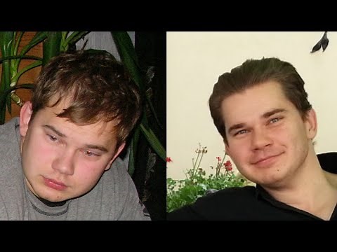 Hair Miniaturization How To Tell And How Does It Look Like