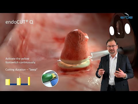 endoCUT® - spark recognition technology in endoscopic procedures / webcast