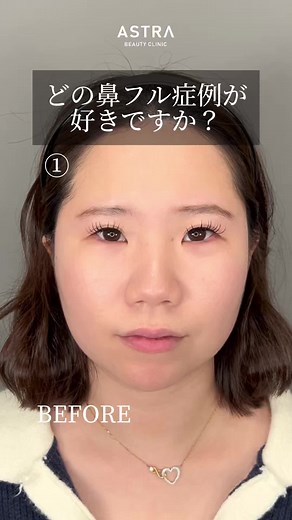 鼻整形の症例紹介と施術内容