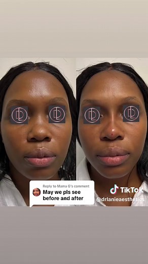 Non-Surgical Nose Thread Results After 15 Minutes