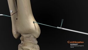 Syndesmotic Fixation Using INVISIKNOT Animation