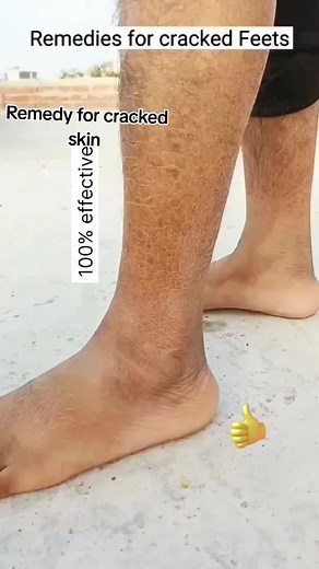 Effective Home Remedies for Cracked Skin on Feet