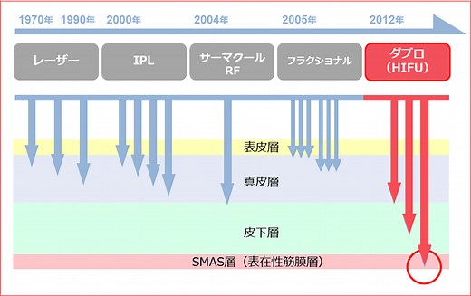 doublo(ダブロ)、痛みが少ない、切らないフェイスリフト | 美容整形の【共立美容外科】