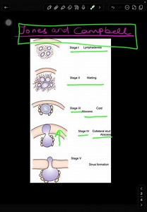 Cold Abscess of Neck l Don’t Incise This