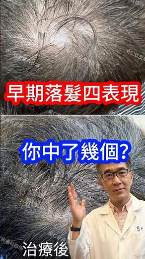 早期落髮四表現 #皮膚科醫生 你中了幾個🤔 #吳仁欽皮膚科診所 #醫美 #屏東微整 #567 #微針筆 #禿頭 #痘痘 #外泌體 #育髮 #雄性禿 #養髮液 #髮際線 #痘疤 #色素 #膠原蛋白