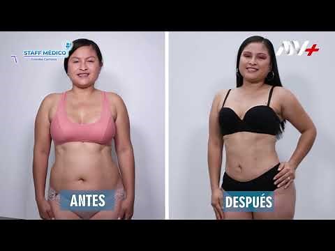 ✨"LIPOESCULTURA Y LIPOTRANSFERENCIA" 👙🤩 / DR. NORMAN ANCO - CIRUJANO PLÁSTICO 👨🏻‍⚕️