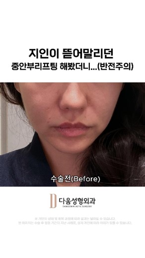 지인이 뜯어말리던 중안부리프팅 실제 전후 결과 #shorts