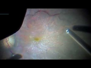 Tips on Vitreomacular traction