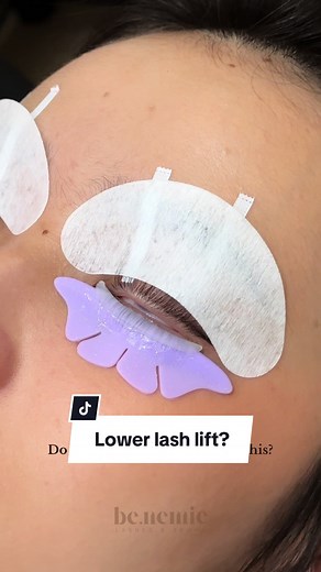 Trichiasis and Lower Lash Lift Solutions