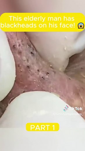 This elderly man has blackheads on his face! 😱 #squeeze #squeezeyuk #acne #pimple #pimplepop #blackhead #satisfying #fyp