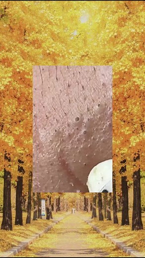 #toenails #ingrowntoenail #toenailremoval #nails #toenail #satisfyingvideo #fyp