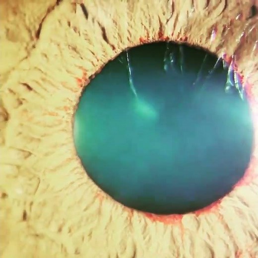 Rubeosis iridis 👁