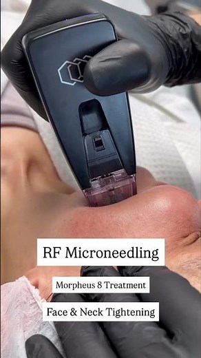 RF Microneedling & Morpheus8 Treatment 💫 | Face & Neck Tightening with Dr. Emin Soyer