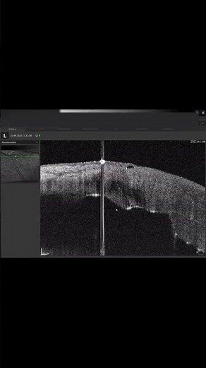 Types of AS-OCT scans and when to use them.