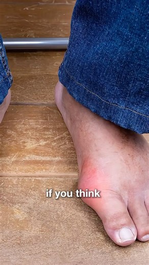 #3/3 Gout Treatment & Prevention Explained