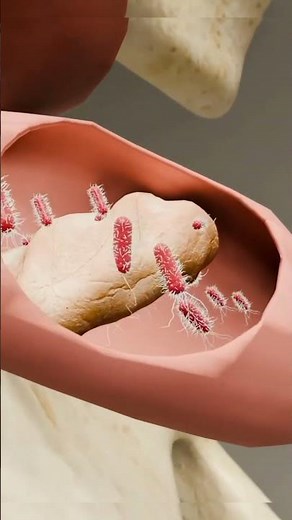 what is Appendix | symptoms | location | treatment | disease | threaten | surgery | 3D animated