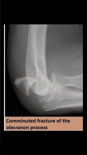 Olecranon process &radial neck fracture causing elbow joint effusion