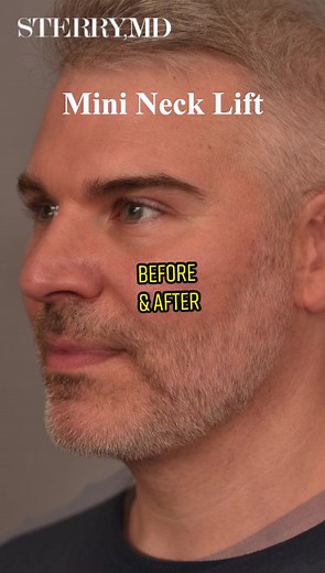 Neck Lift Transformation: Before and After Mini Lifting