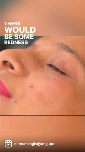 ⚡️Mole Removal by Radio Frequency Ablation⚡️#shorts