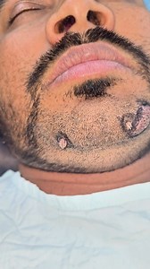 273K views · 1.3K reactions | Filiform Wart | Dr. Khaled Hasan Milu | Facebook