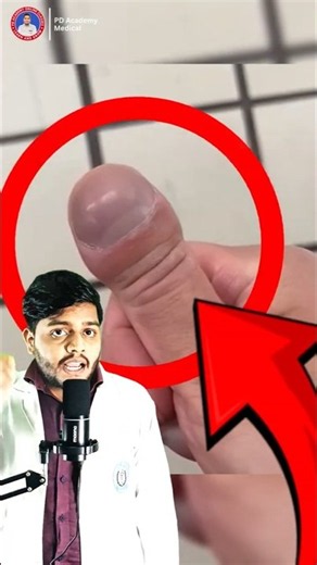 The scary truth about nail clubbing #healthawareness #shorts
