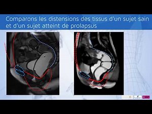 Mobilité des organes pelviens féminins. Prolapsus (descente d'organe). Version courte