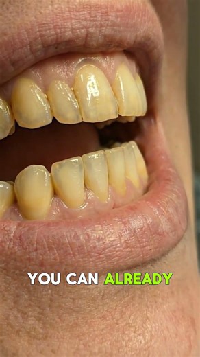 Yellow Teeth to Pearl White in Seconds 😳✨