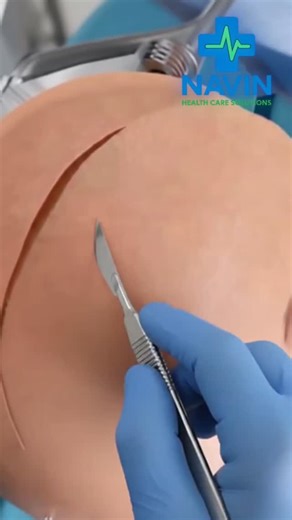 Navin Healthcare Solutions on Instagram: "How is brain AVM surgery done? Brain AVM (arteriovenous malformation) surgery depends on the AVM’s size, location, and bleeding risk. Doctors first map the AVM using MRI, CT angiography, or digital subtraction angiography (DSA). 🏥 Navin Health Care Solutions Delhi-NCR का भरोसेमंद कैशलेस हेल्थकेयर पार्टनर 📞 Call / WhatsApp: +91 8755202215 👤 Mr. Navin Kumar #MedicalEducation #Neurosurgery #BrainHealth #AVM #ScienceExplained #DocTalk #MrCologist #ReelsIn