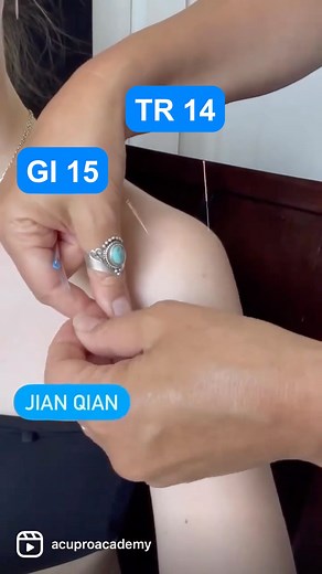 Protocole de Base d'Acupuncture pour l'Épaule 🔥 Il y a tellement de problèmes d'épaule comme la capsulite adhésive, les blessures de la coiffe des rotateurs et plus encore. 🔥 Ce protocole de base d'acupuncture est pour les douleurs antérieures de l'épaule. J'utilise des ventouses et le Tui Na (massage chinois). 🔥 Ensuite, je pique GI 4, GI 11, GI 14, GI 15, TR/SJ 14, et le point supplémentaire JIAN QIAN. De plus, j'ajoute toujours E 38 comme point distal sur le membre opposé à celui affecté. 