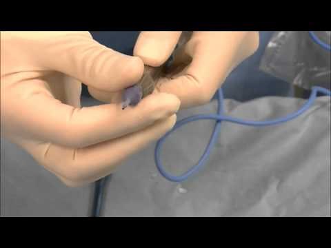 Cataract surgery machine (US setting: Alcon Infinity)