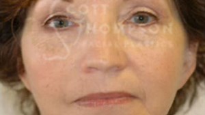 Facelift Before and After Photos