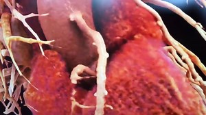 3.7K views · 52 reactions | This is a Cardiac CT scan, from a Somatom Force, which was reformatted using the Siemens cinematic rendering feature on Syngo Via advanced visualization software. I discussed this technology when it was first introduced at RSNA 2016 at about 14:20 in this VIDEO - https://www.dicardiology.com/videos/editor’s-choice-most-innovative-new-technologies-rsna-2016 #SCCT2018 #SCCT #SCCT18 Siemens Healthineers | Diagnostic and Interventional Cardiology - DAIC | Facebook