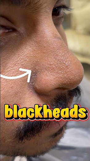 Nose Blackheads: How to Remove Safely at Home (Easy Guide)