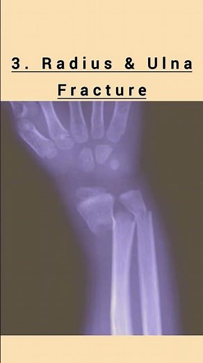 Types of wrist fracture.