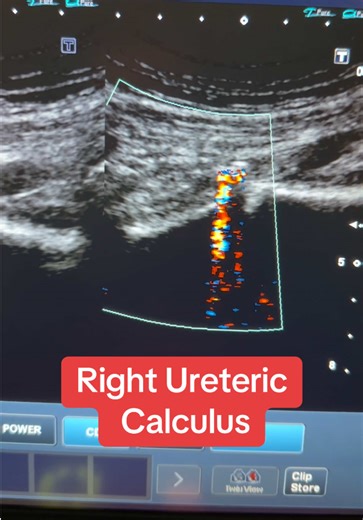 Ureteric Calculus with twinkling Artefact #urology #calculus #uti #sonography #ultrasound