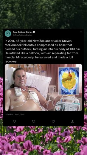 The Man Who Inflated Like a Balloon and Lived #Shorts