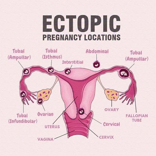 ⚠️ ECTOPIC PREGNANCY When the baby grows outside the uterus 🫁 🔹 Severe abdominal pain 🔹 Vaginal bleeding 🔹 Dizziness / fainting ❗ Emergency! Needs quick medical care. #EctopicPregnancy #WomensHealth #PregnancyAwareness #KnowTheSigns | Mum_world_