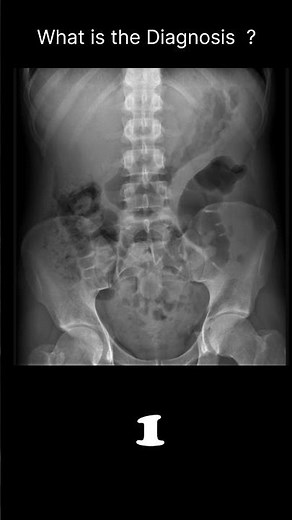 Normal bowel gas pattern Abdominal X-ray Abnormalities Normal reference 60 #‪@radiologychannel007‬