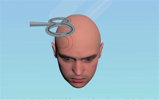 人和医院-经颅磁刺激 动画