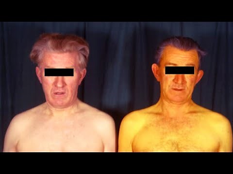 Gilbert Syndrome Signs, Symptoms, Causes, Treatment