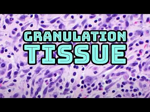 Granulation tissue (early scar): Reactive myofibroblasts look scary, but NOT CANCER! pathology