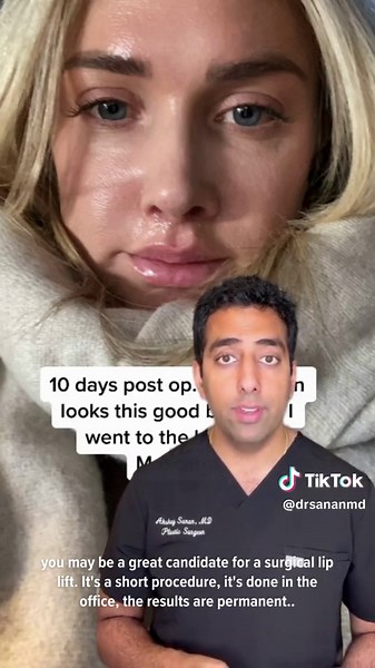 Surgical Lip Lift: The Celebrity Secret for Youthful Lips