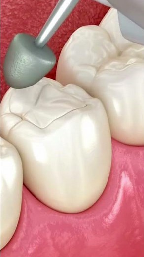 Root Canal Treatment (RCT) and dental filling explained in a quick and simple way! 🦷✨