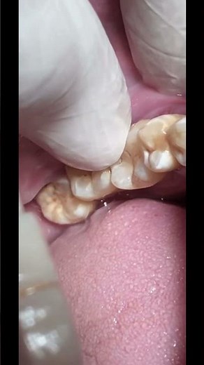 Molar tooth mobility #dentalcare