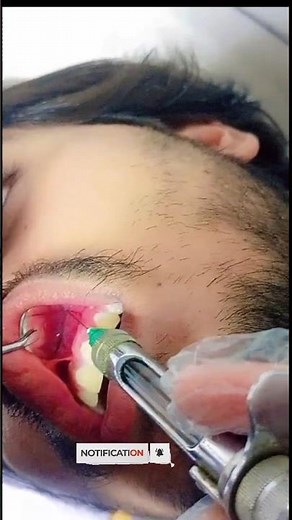 Simple & Painless Tooth Extraction – Full Process#shorts#dentist